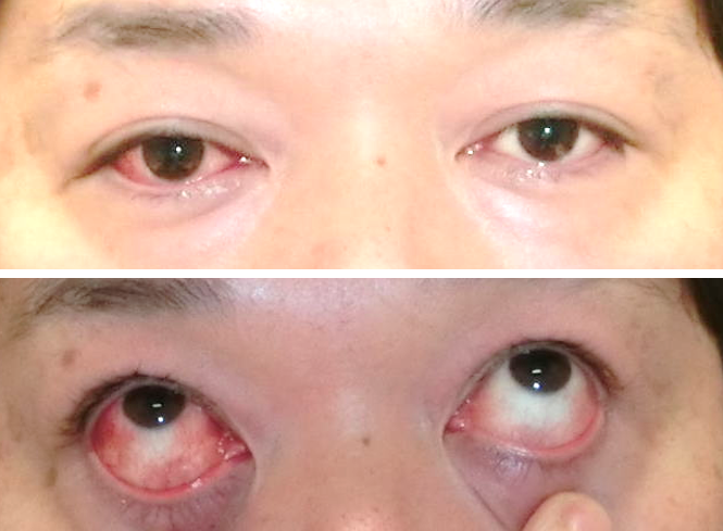 一般用医薬品 Otc薬 長期連用点眼による充血 目医者情報