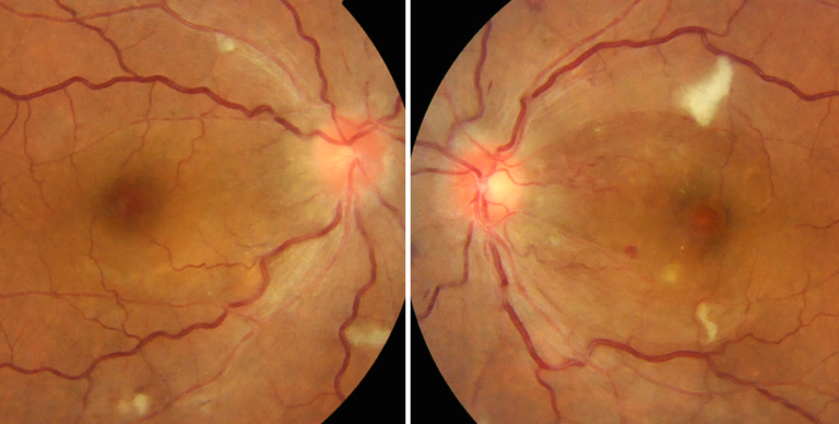 高血圧性網膜症の症状